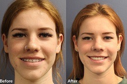 Jaw Surgery Cost in Dubai