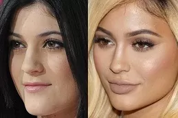Lip Fillers Injections Abu Dhabi