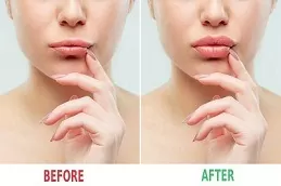 Lip Fillers Injections in dubai