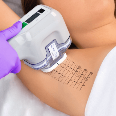 Miradry Treatment for Excessive Sweating in Dubai & Abu Dhabi Cost