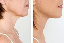 Nefertiti Lift For Jawline Dubai & Abu Dhabi