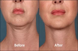 Nefertiti Lift Treatment For Jawline Dubai