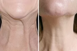 Nefertiti Lift Treatment For Jawline