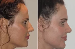 Non Surgical Nose Job Abu Dhabi