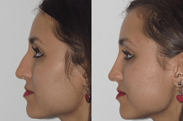 Non Surgical Nose Job Dubai