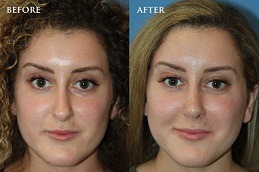 Non Surgical Nose Job in Abu Dhabi