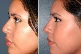 Non Surgical Nose Job in Dubai, Abu Dhabi & Sharjah