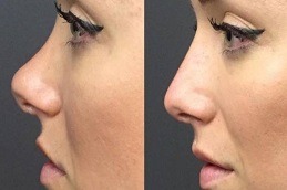 Non Surgical Nose Job in Dubai & Abu Dhabi