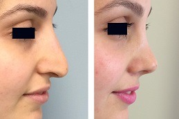 Non Surgical Nose Job in Dubai