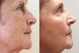 Pigmentation Treatment Dubai