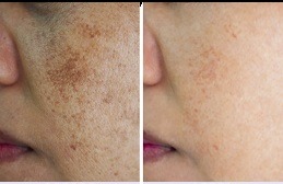 Pigmentation Treatment