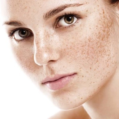 Pigmentation Treatment in Dubai, Abu Dhabi & Sharjah Hyperpigmentation Cost