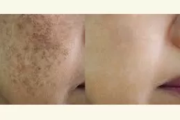 Best Pigmentation Treatment Dubai