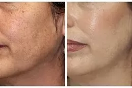 Pigmentation Treatment in Dubai