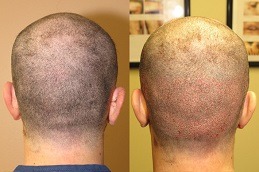 Robotic Hair Transplant Abu Dhabi