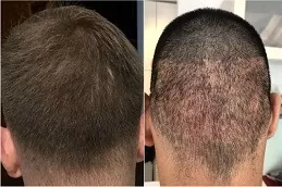 Robotic Hair Transplant Clinic in Dubai