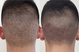 Robotic Hair Transplant in Abu Dhabi