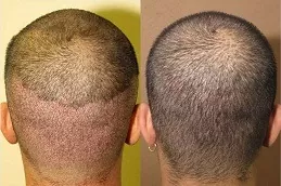 Robotic Hair Transplant in Dubai & Abu Dhabi