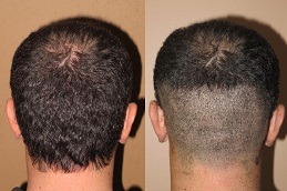 Robotic Hair Transplant in Dubai