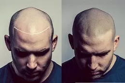 Scalp Micro Pigmentation in Abu Dhabi