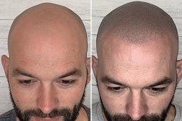 Scalp Micro Pigmentation in Dubai & Abu Dhabi