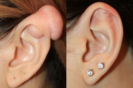 Scars & Keloid Treatment Abu Dhabi