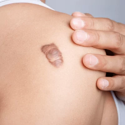 Scars & Keloid Treatment in Dubai, Abu Dhabi & Sharjah Cost & Price