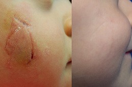 Scars & Keloid Treatment in Dubai & Abu Dhabi