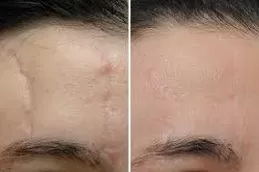 Scars & Keloid Treatment in Dubai