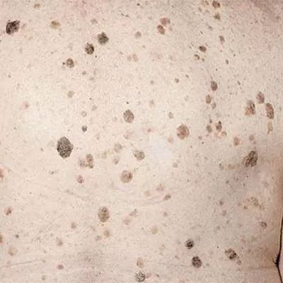 Seborrheic Keratosis Treatment in Dubai & Abu Dhabi Cost & Prices