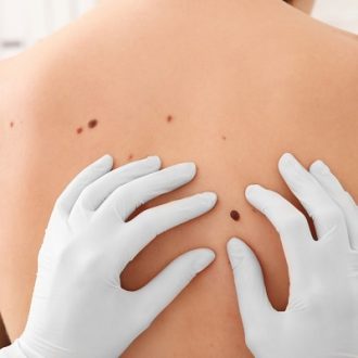 Skin Neoplasm Removal Dubai & Abu Dhabi