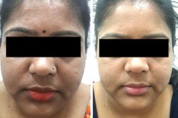 Skin Whitening Treatment Cost in Dubai