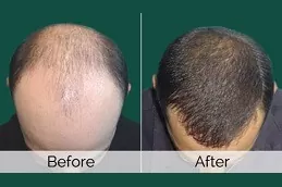 Stem Cell Hair Transplant Clinic in Dubai