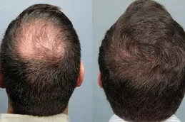 Stem Cell Hair Transplant in Abu Dhabi
