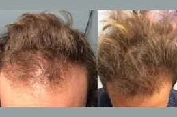 Stem Cell Hair Transplant in Dubai & Abu Dhabi