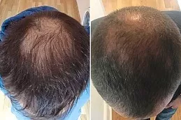 Stem Cell Hair Transplant in Dubai