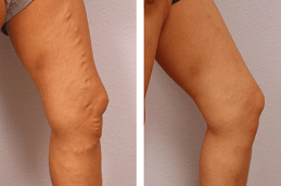 Varicose Veins Treatment Abu Dhabi