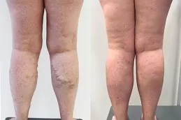 Varicose Veins Treatment Clinic in Abu Dhabi