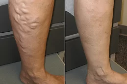 Varicose Veins Treatment Clinic in Dubai