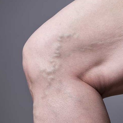 Varicose Veins Treatment in Dubai, Abu Dhabi & Sharjah Varicose Cost