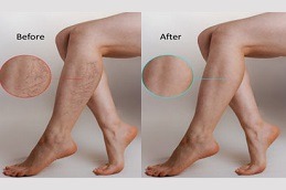 Varicose Veins Treatment in Dubai & Abu Dhabi