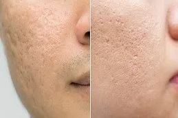 acne scar treatment in Dubai UAE