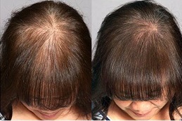 dermatologist for hair loss in dubai