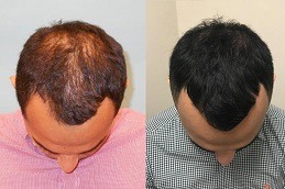Best PRP Hair Treatment in Dubai & Abu Dhabi | PRP Therapy Cost UAE