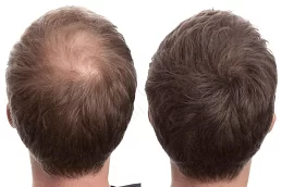 stem cell hair transplant dubai