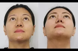 Alarplasty in Dubai & Abu dhabi