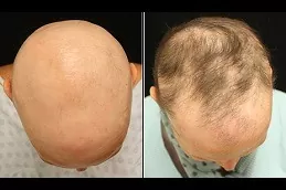 Alopecia Areata Treatment Abu Dhabi