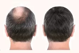 Alopecia Areata Treatment Clinic Abu Dhabi