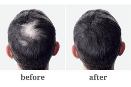 Alopecia Areata Treatment Clinic in Dubai