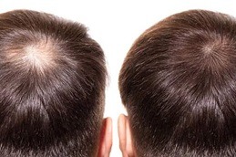 Alopecia Areata Treatment Dubai & Abu Dhabi